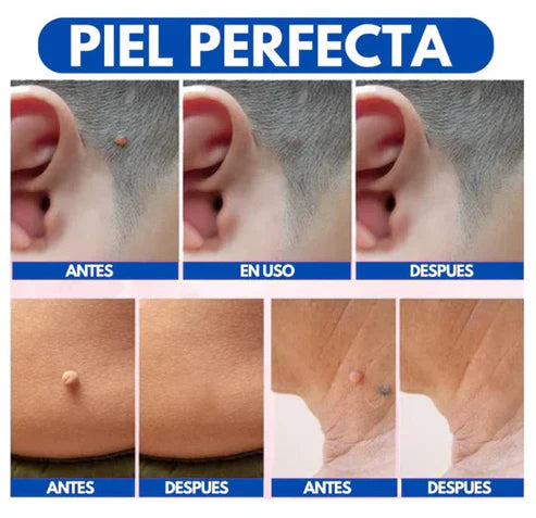 WART REMOVEDOR DE VERRUGAS Y LUNARES