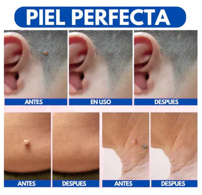 WART REMOVEDOR DE VERRUGAS Y LUNARES